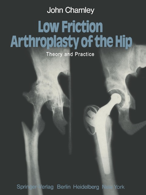 Low Friction Arthroplasty of the Hip: Theory and Practice