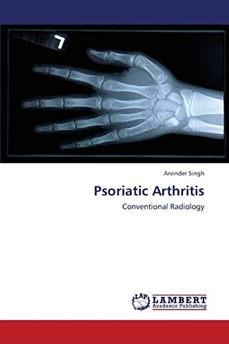 Psoriatic Arthritis