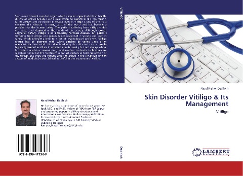 Skin Disorder Vitiligo & Its Management: Vitiligo