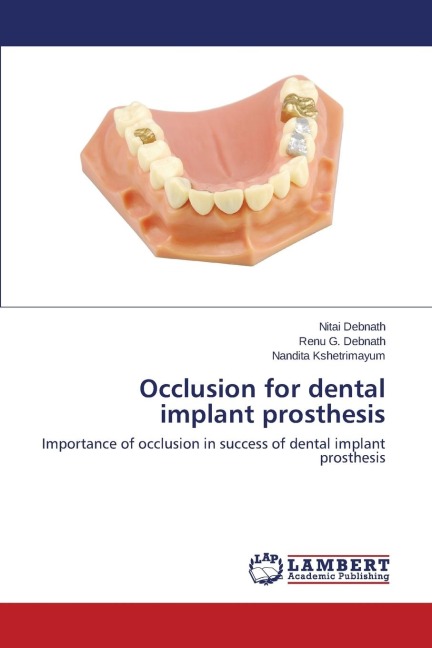 Occlusion for dental implant prosthesis: Importance of occlusion in success of dental implant prosthesis