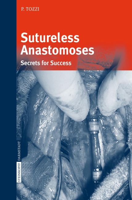 Sutureless Anastomoses: Secrets for Success