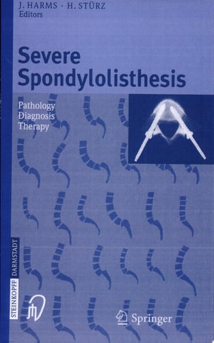 Severe Spondylolisthesis Pathology, Diagnosis, Therapy