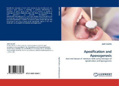 Apexification and Apexogenesis: Root end closure of immature teeth using technique of Apexification and Apexogenesis