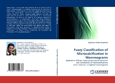 Fuzzy Classification of Microcalcification in Mammograms: Application of fuzzy image processing for detection and classification of microcalcifications (small tumours) in digitized mammograms