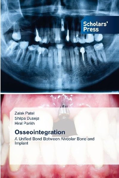 Osseointegration: A Unified Bond Between Alveolar Bone and Implant