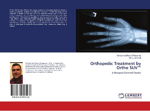 Orthopedic Treatment by Ortho SUV(TM): A Hexapod External Fixator