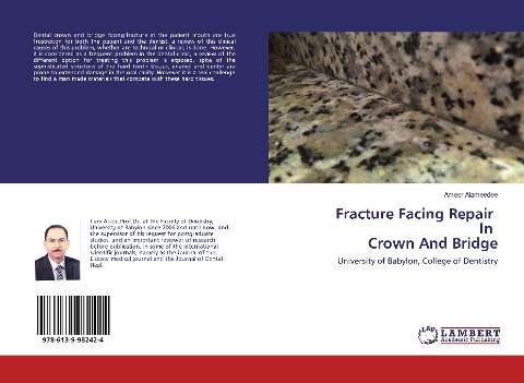 Fracture Facing Repair In Crown And Bridge: University of Babylon, College of Dentistry