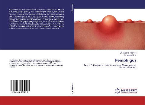 Pemphigus: Types, Pathogenesis, Manifestations, Management, Recent advances