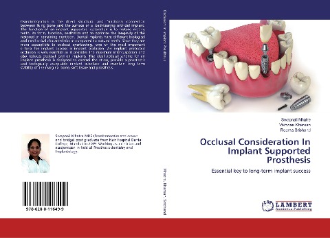 Occlusal Consideration In Implant Supported Prosthesis: Essential key to long-term implant success