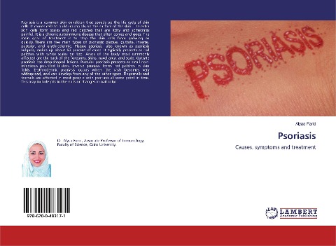 Psoriasis: Causes, symptoms and treatment