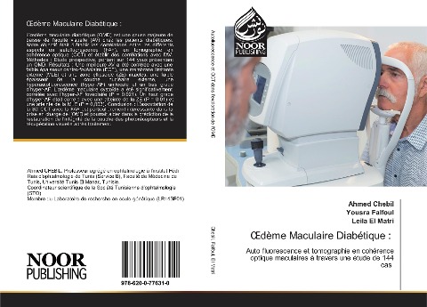 ¿dème Maculaire Diabétique :: Auto fluorescence et tomographie en cohérence optique maculaires à travers une étude de 144 cas