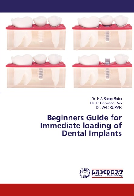 Beginners Guide for Immediate loading of Dental Implants