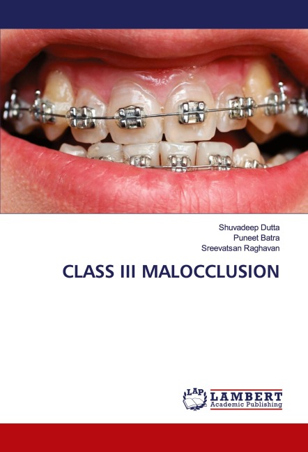 CLASS III MALOCCLUSION