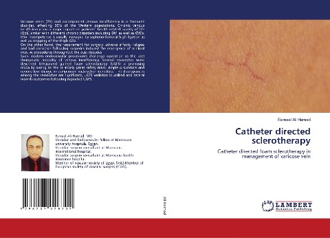 Catheter directed sclerotherapy: Catheter directed foam sclerotherapy in management of varicose vein