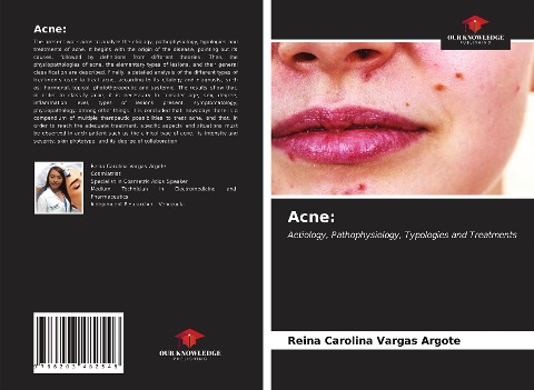 Acne:: Aetiology, Pathophysiology, Typologies and Treatments