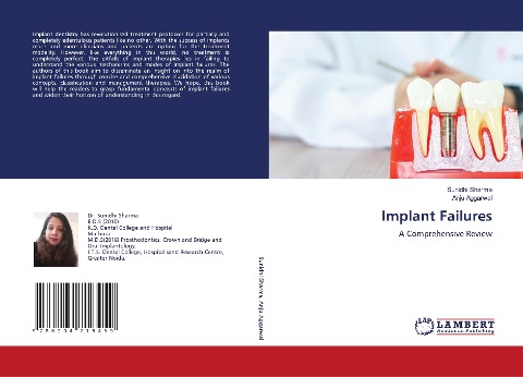 Implant Failures: A Comprehensive Review