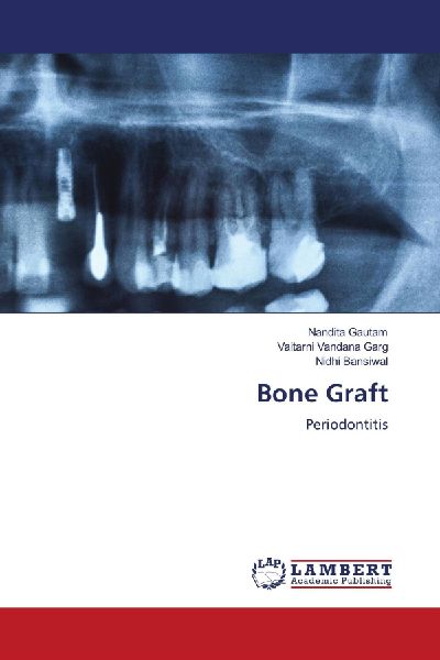 Bone Graft: Periodontitis