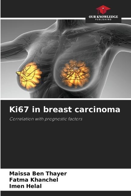 Ki67 in breast carcinoma: Correlation with prognostic factors