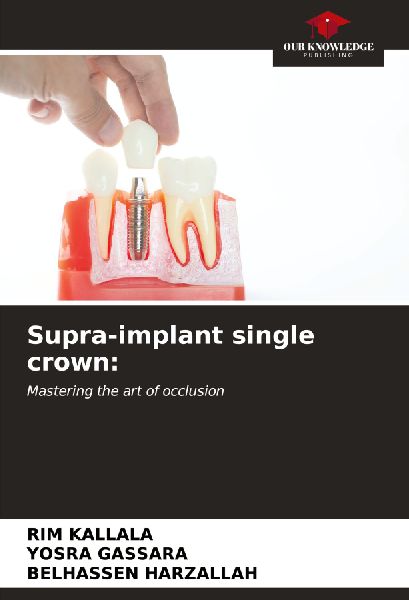 Supra-implant single crown:: Mastering the art of occlusion