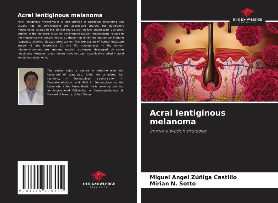 Acral lentiginous melanoma: Immune evasion strategies