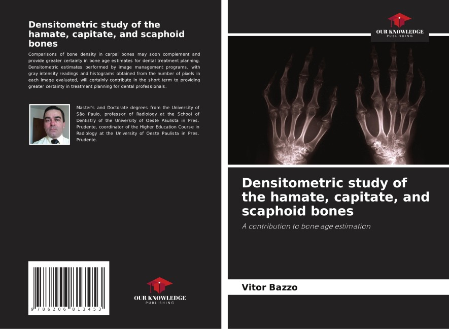 Densitometric study of the hamate, capitate, and scaphoid bones: A contribution to bone age estimation
