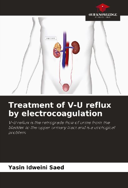 Treatment of V-U reflux by electrocoagulation: V-U reflux is the retrograde flow of urine from the bladder to the upper urinary tract and is a urological problem