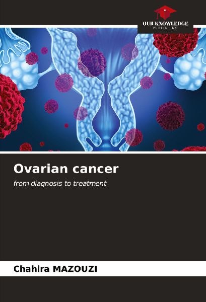Ovarian cancer: from diagnosis to treatment