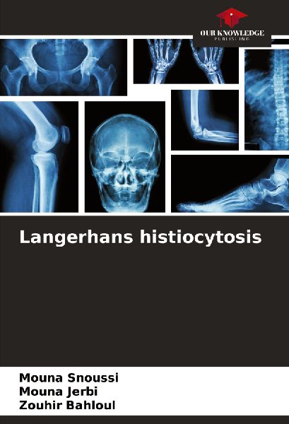 Langerhans histiocytosis