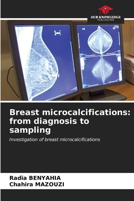 Breast microcalcifications: from diagnosis to sampling: Investigation of breast microcalcifications