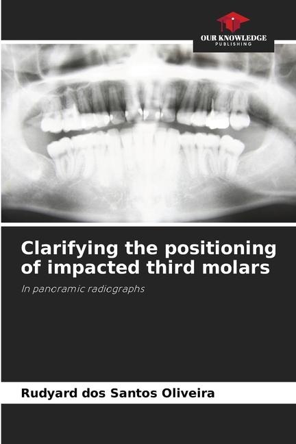Clarifying the positioning of impacted third molars: In panoramic radiographs