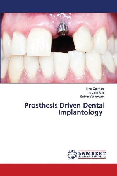 Prosthesis Driven Dental Implantology