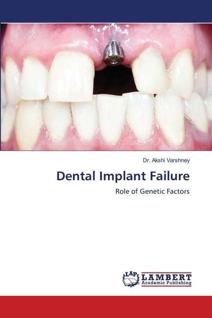 Dental Implant Failure: Role of Genetic Factors