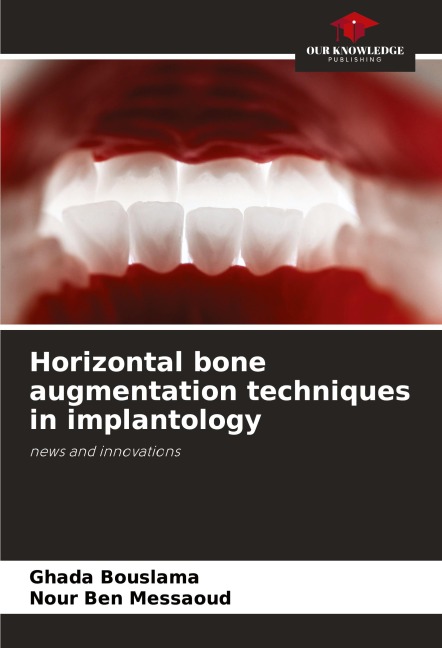 Horizontal bone augmentation techniques in implantology: news and innovations