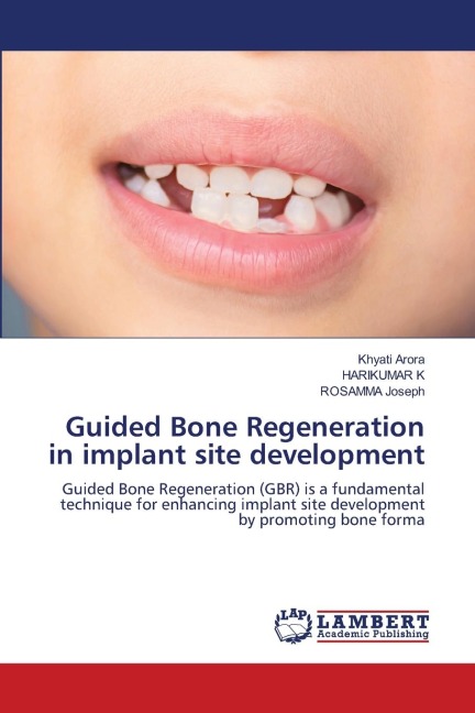 Guided Bone Regeneration in implant site development: Guided Bone Regeneration (GBR) is a fundamental technique for enhancing implant site development by promoting bone forma