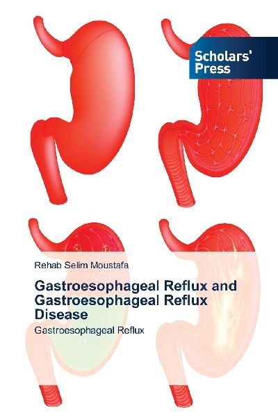 Gastroesophageal Reflux and Gastroesophageal Reflux Disease: Gastroesophageal Reflux