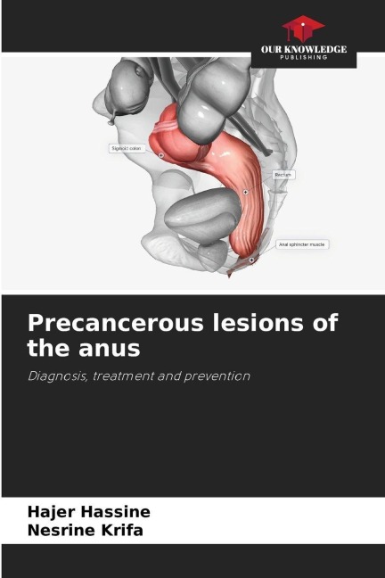 Precancerous lesions of the anus: Diagnosis, treatment and prevention
