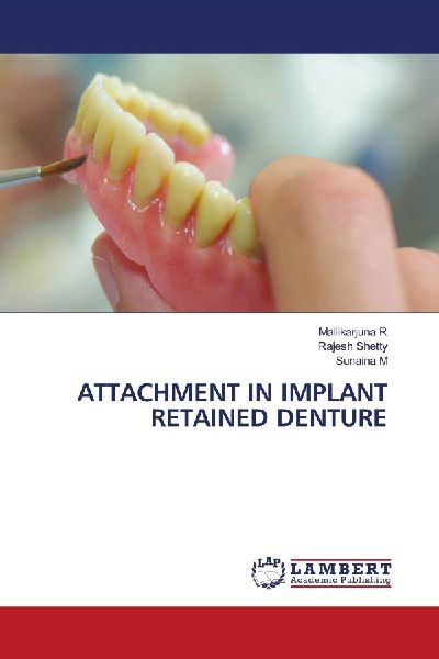 ATTACHMENT IN IMPLANT RETAINED DENTURE