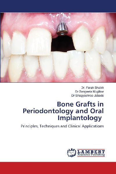 Bone Grafts in Periodontology and Oral Implantology: Principles, Techniques and Clinical Applications