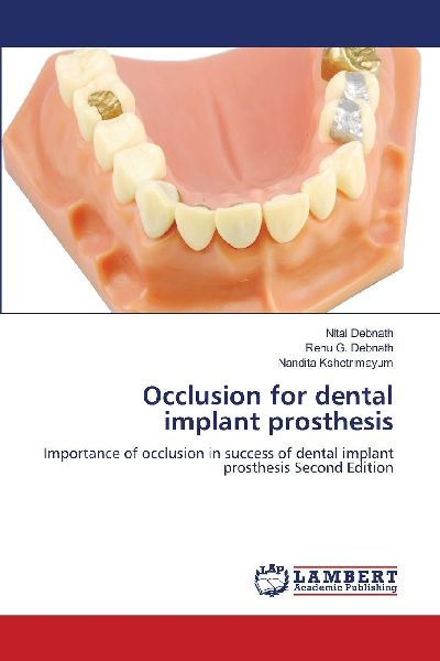 Occlusion for dental implant prosthesis: Importance of occlusion in success of dental implant prosthesis Second Edition