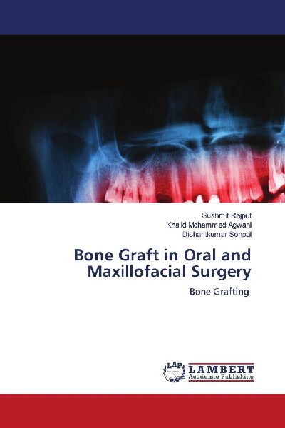 Bone Graft in Oral and Maxillofacial Surgery: Bone Grafting