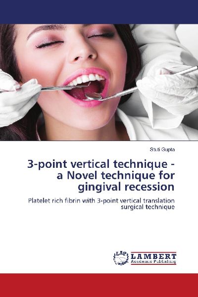 3-point vertical technique - a Novel technique for gingival recession: Platelet rich fibrin with 3-point vertical translation surgical technique