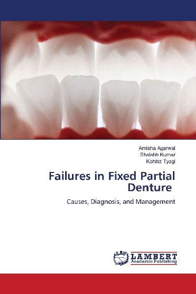 Failures in Fixed Partial Denture: Causes, Diagnosis, and Management