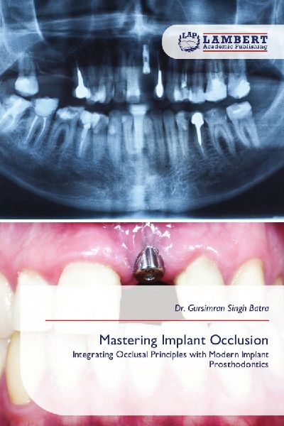 Mastering Implant Occlusion: Integrating Occlusal Principles with Modern Implant Prosthodontics