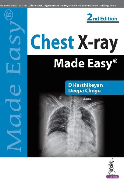 Chest X-ray Made Easy