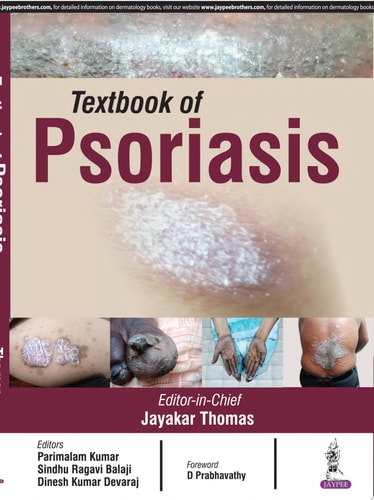 Textbook of Psoriasis