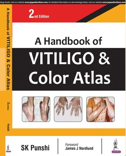 A Handbook of Vitiligo & Color Atlas