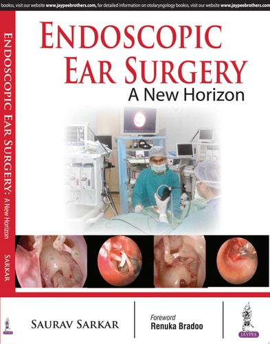 Endoscopic Ear Surgery A New Horizon