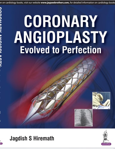 Coronary Angioplasty Evolved to Perfection