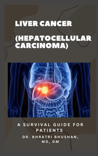 Liver Cancer (Hepatocellular Carcinoma) A Survival Guide for Patients