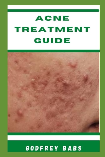 Acne Treatment Guide Manage Acne with Ease